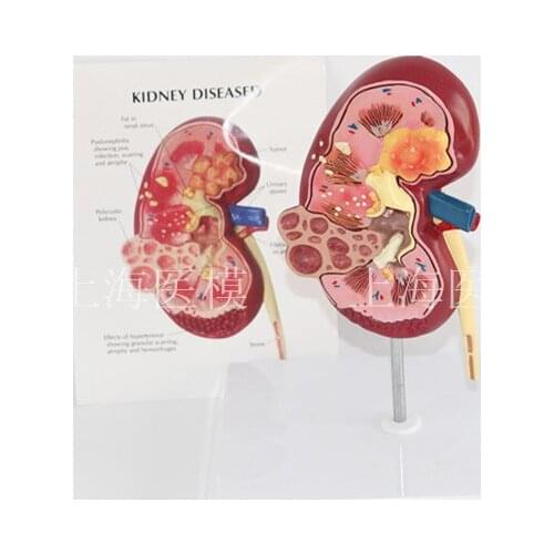 Kidney disease model urology kidney nephron renal glomerulus kidney anatomical model