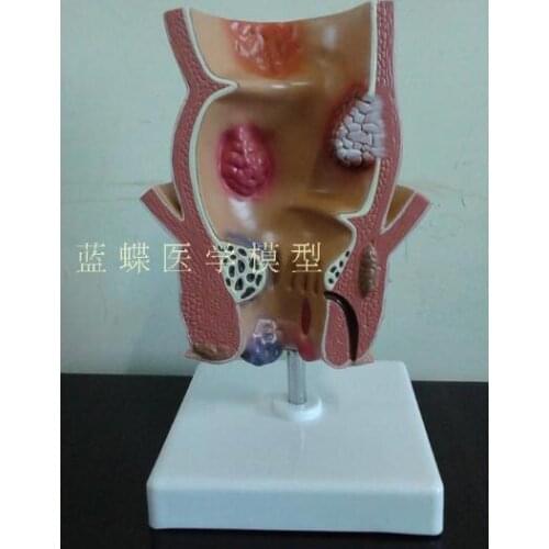 Anorectal disease hemorrhoid model rectal disease model
