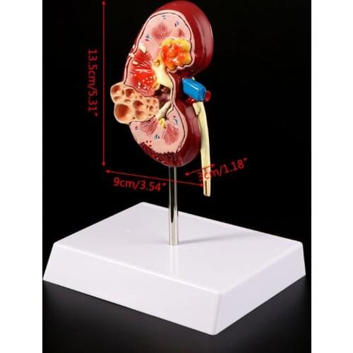 Life Size Human Kidney Diseased Model Anatomical Anatomy Diseased Pathological Stone Organ Teaching Supplies Dropship
