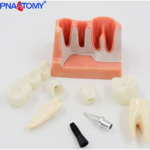 Removable Dental Teeth Implant Restoration Model Pathological Nerve Dental Disease Analysis Demonstration Tool Dental Model