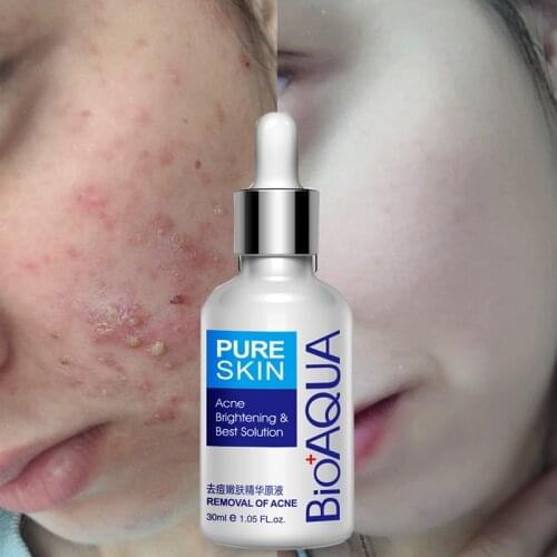BIOAQUA Brand 30ml Acne Treatment Essence Acne Scar Removal Acne Spots Facial Skin Care Whitening Moisturizing Face Care