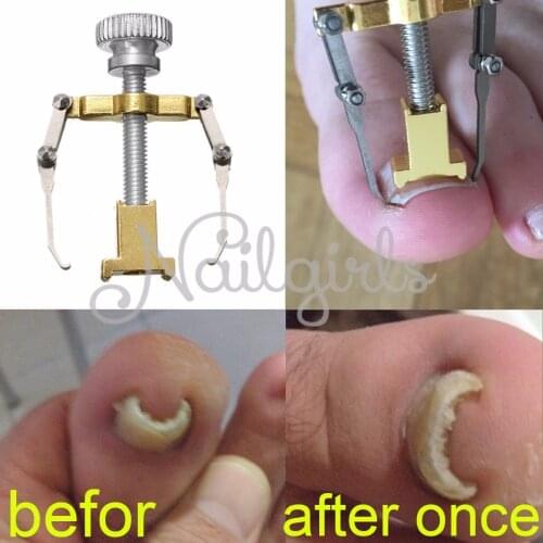 Ingrown Toenails Toe Nail Care Tool Professional File Corrector Device Pedicure Foot Orthotic Acronyx Onyxis bunion Protector
