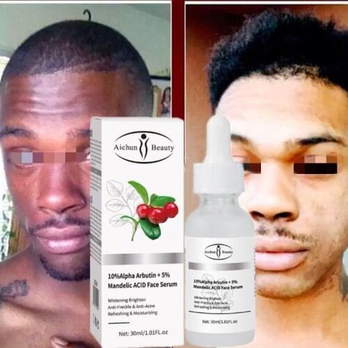 Arbutin Skin Whitening Serum Lightening Kojic Acid Serum Brightening Bleaching Dark Spot Cream 30Ml