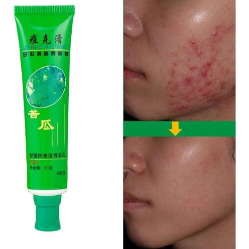 30g Face Removal Acne Cream Pimple Spots Scar Treatment Adult Skin Care Repair