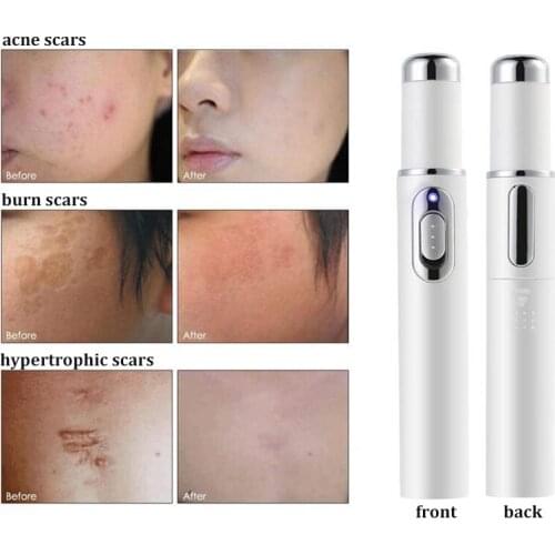 Heath Blue Light Therapy Varicose Veins Treatment Laser Pen Soft Scar Wrinkle Removal Treatment Acne Laser Pen Do Dropshipping