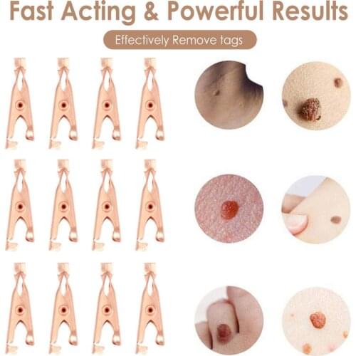 Skin Tags Remover Copper Small Wart Tattoo Clip Extractor Tools