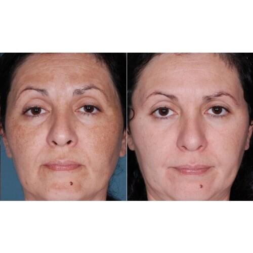 SALICYLIC ACID SKIN PEEL 5% 10% 20% 30% ACNE TREATMENT BLACKHEADS 30ml Free Ship