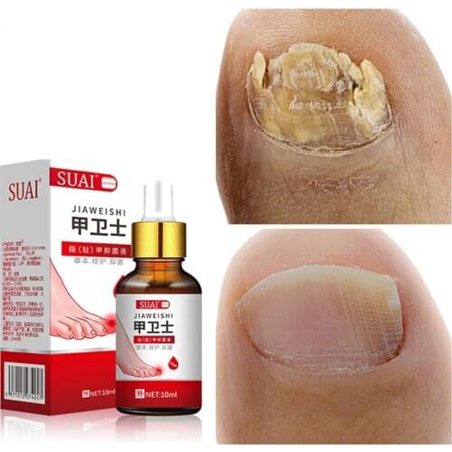 Nail Fungal Treatment Feet Care Essence Nail Foot Whitening Toe Nail Fungus Removal Gel Anti Infection Paronychia Onychomycosis
