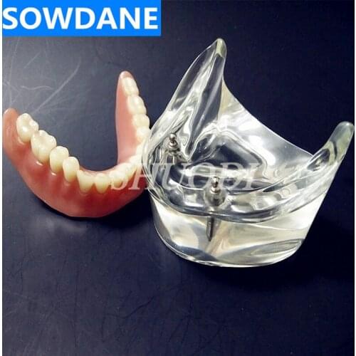 Clinic Decoration Dental Overdenture Interior Mandibular Lower with 2 Implant Restoration Teeth Study Teach Model