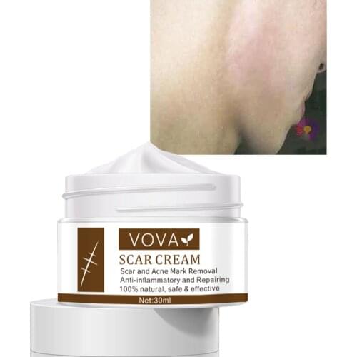 1pcs 30ml Scar Cream Acne Scar Cream