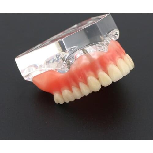 Dental Teeth Model Removable Interior 4 Implants Overdenture with Implants Teeth Model for Teaching Study Model Teeth Dental