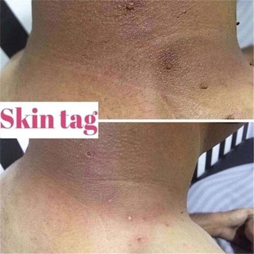 Genital Wart Treatment Papillomas Removal of Warts Moles Liquid Against Tags Removing Removal From Remover Wart Skin liuld K4U0