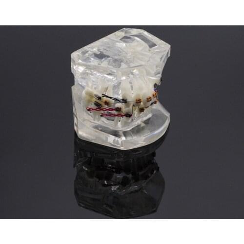 Dental Tooth Orthodontic Model Malocclusion Science Teaching Model Transparent Teeth Model Clinic