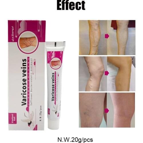 20g Treatment Varicose Veins Ointmnet Vasculitis Phlebitis Spider Cream Varicosity Angiitis Removal Herbal Medical Plaster