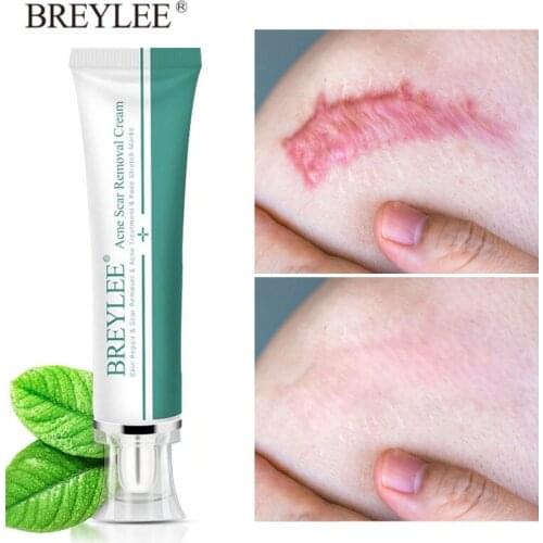 BREYLEE Acne Scar Removal Cream Scar Remover Acne Treatment Face Pimples Fade Stretch Marks Gel Skin Repair Body Scar Skin Care
