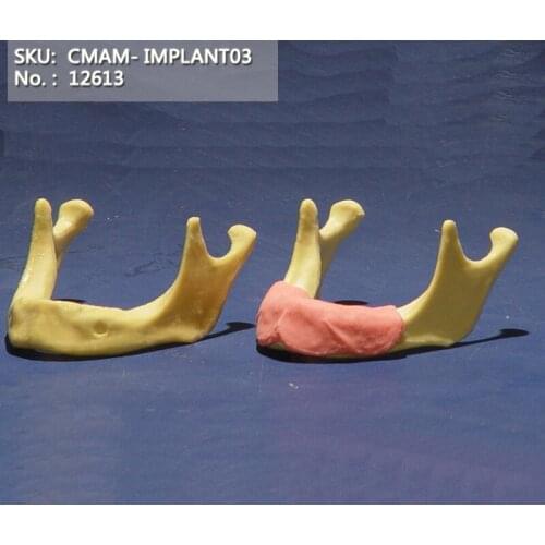 CMAM/12613 Dental- Toothless jaw, Implant, Human Oral Dental Medical Teaching Anatomical Model