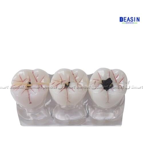 Dental model of four times demonstration model of caries evolution caries development of doctor-patient communication patholo