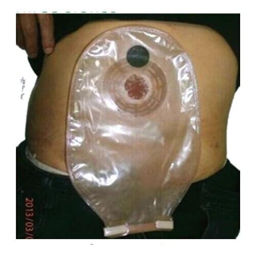 One pc colostomy bag with drainage (classical stoma pouch) disposable ostomy care
