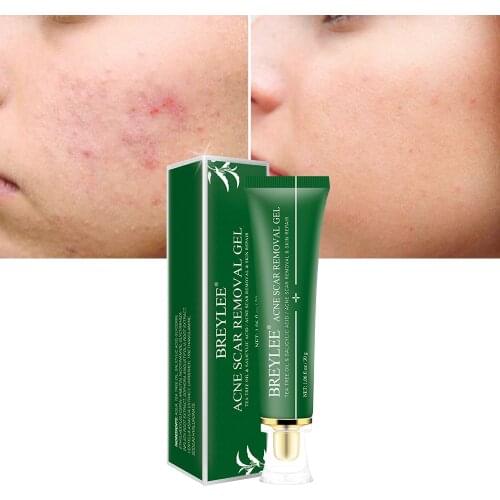 BREYLEE 30g Effective Weakening Acne Scar Removal Gel Fade Acne Remove Skin Pigmentation Soothing Prevent whiten Acne Treatment