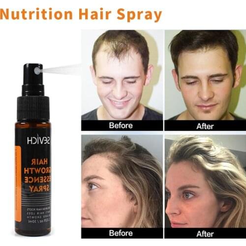 30ml Hair Growth Essence Spray Hair loss Treatment Preventing Hair Loss spray hair Growth Essence Hair Care beauty products