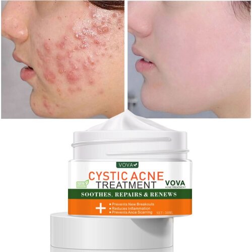 Effective Acne Removal Cream Acne Treatment Fade Acne Spots Oil Control Shrink Pores Whitening Moisturizing Acne Cream Skin Care