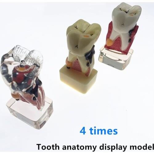 Dental Teeth Model Comprehensive Periodontal Pathological Disease Model For Science Study Teaching Communication