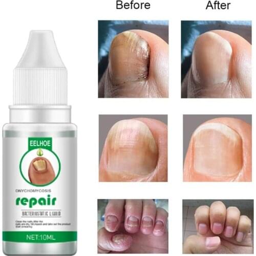 10/20/30ML Nail Fungus Treatments Feet Care Essences Fungal Nail Foot Toe Repair Removal Gel Nail Repair Serum