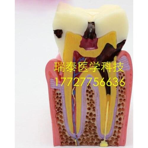 6X,9*7.6cm,Medical advanced resin dental Tooth model Doctor-patient communication teaching