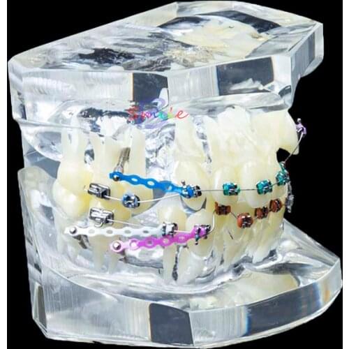 High Quality Dental Orthodontic Study Teach Teeth Model with Metal Brackets Brace Dental Teeth Teaching Model