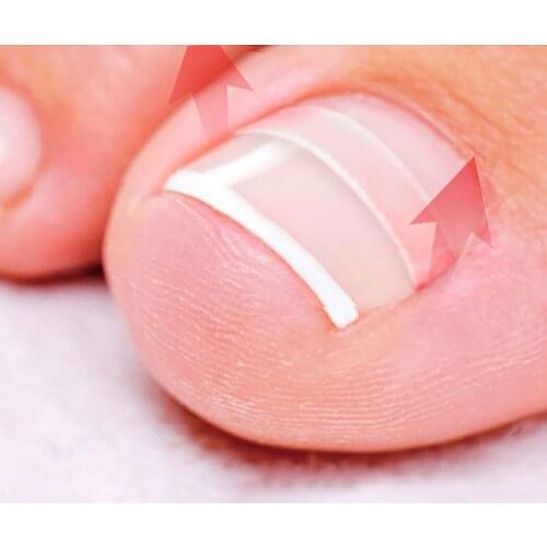 10pcs Ingrown Toe Nail Corrector Parches Stickers Paronychia Correction Treatment Elastic Sticker Foot Care Tools