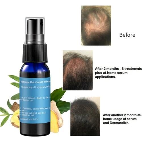 Fast Hair Growth Serum Essential Oil Ginger Anti Hair Loss Treatment Hair Nutrition Liquid Damaged Hair Repair Regrowth Products
