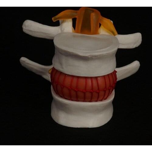 Human Lumbar Model Anatomical Disc Herniation Medical Learn Aid Instrume