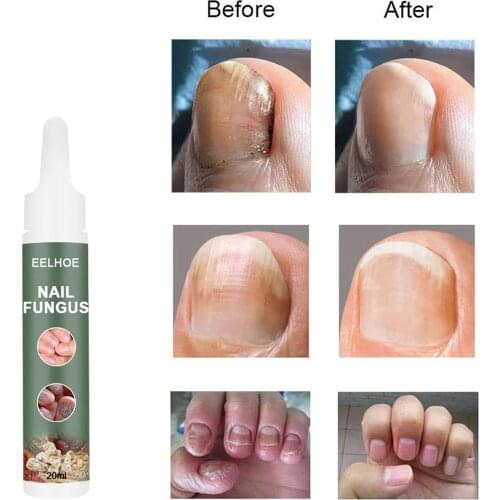 20ml Manicure Antibacterial Cream Fungal Nail Treatment Serum Anti-Fungal Nail Infection Herbal Toe Fungus Foot Repair Essence