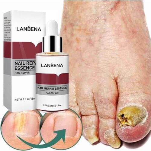 Nail Fungal Treatment Foot Nail Repairing Toe Nail Fungus Removal Gel Anti Infection Paronychia Onychomycosis Feet Care Essence