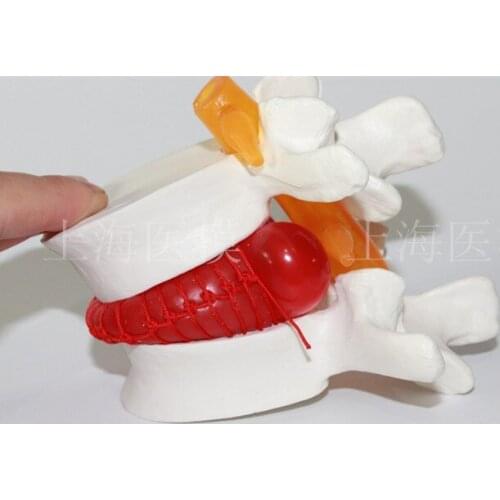 Human lumbar disc herniation model demonstration model of lumbar vertebral spine model