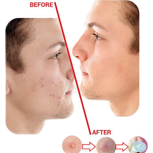 Acne Pimple Healing Patch-Absorbing Cover Invisible/Blemish Spot/Hydrocolloid/Skin Treatment/Facial Stickers Blends In with Skin