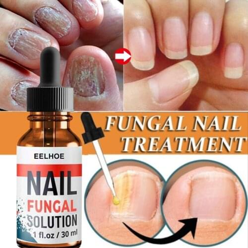 10/20/30ml Fungal Nail Treatment Serum Care Repair Foot Nail Fungus Removal Onychomycosis Anti-infective Paronychia Essences