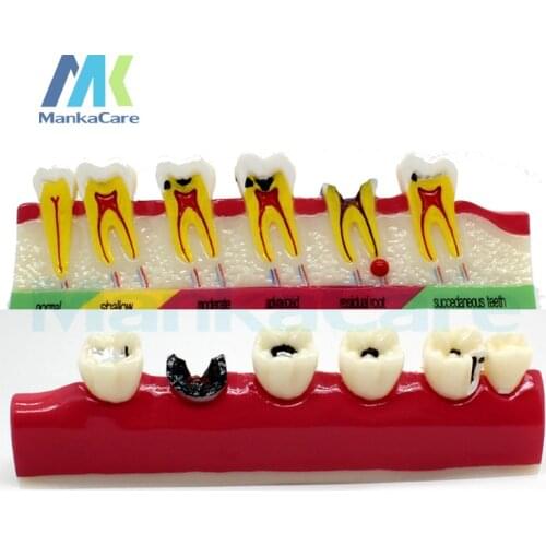 1 pc Dental Model Periodontal Disease Assort Tooth Typodont Teach Model Orthodontic Braces dental model
