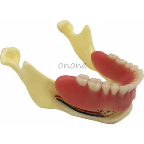 1pcs Dental Implant Denture Restoration Mandible Display Model with 4 Nail Teeth Model