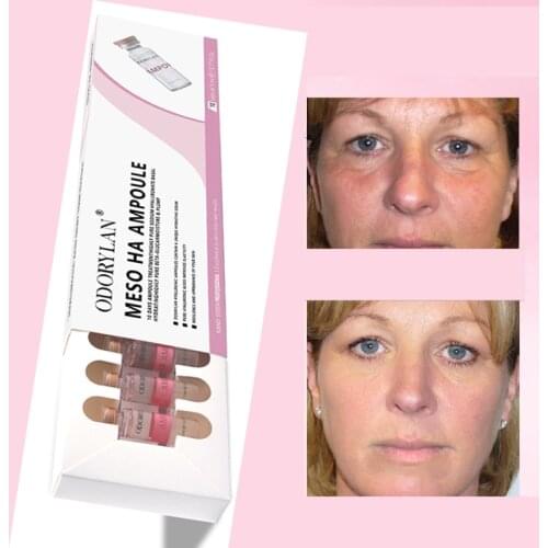 10 vials Cross-linked Hyaluronic Acid Ampoule Molecular Mesotherapy HA Collagen Hyaluronic Acid Skin Repair Whitening Serum