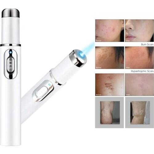 Blue Light Therapy Varicose Veins Treatment Laser Pen Soft Scar Wrinkle Blemish Dead Skin Removal Face Massage Acne Laser Pen