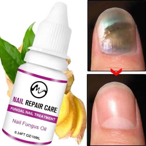 Minch Powerful Nail Fungal Treatment Onychomycosis Removal Antifungal Nail Care Repair Liquid Nail Repair Supplies 10ml