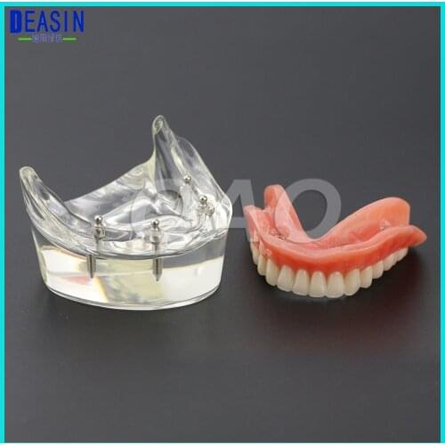 Dental Teaching Teeth Study Model Overdenture Inferior 4 Implant Demo Model