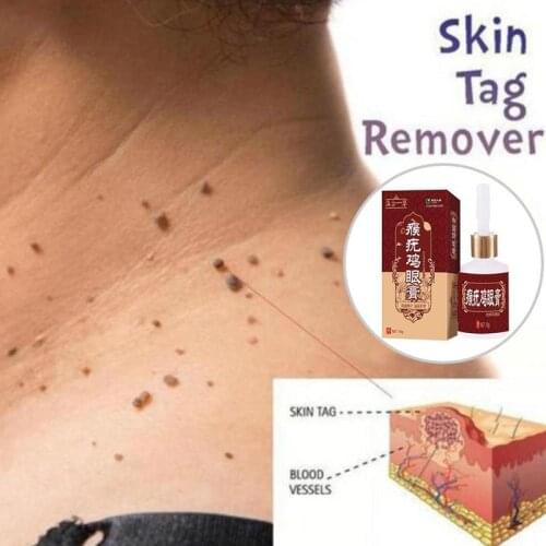 10ml Skin Tag Remover Tu Kill Medical Tu Kill Remover Skin Tag Mole Genital Wart Remover Foot Corn Remover Liquid Products