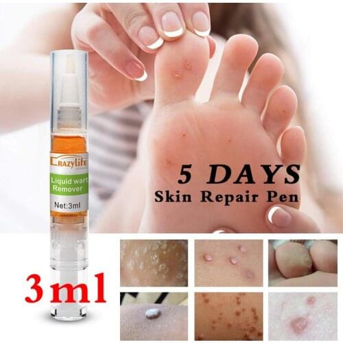 2Pcs Crazylife foot cleft removal toe wart liquid wart pen skin tag Foot Corn Removal Warts callus thorn patches Corns of foot