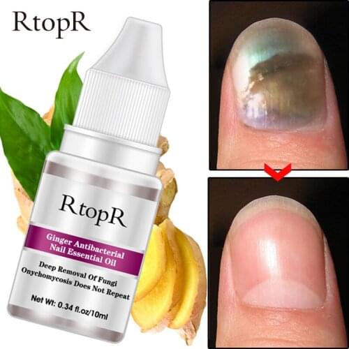 RtopR Fungal Nail Repair Essence Serum Care Treatment Foot Nail Fungus Removal Gel Anti Remove Onychomycosis Toe Repair fluid
