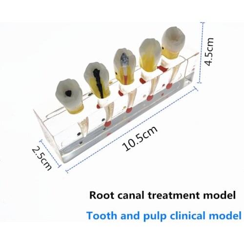 Teeth Model Endodontic Treatment Model Root canal treatment model