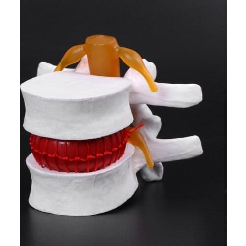 39XD Human Anatomical Lumbar Disc Herniation Model Learn Aid Anatomy Instrume
