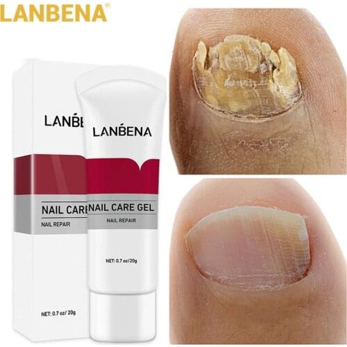 LANBENA Nail Fungus Removal Crema Onychomycosis Fungal Nail Treatment Paronychia Anti Infection Feet Toe Fungal Nail Care Gel