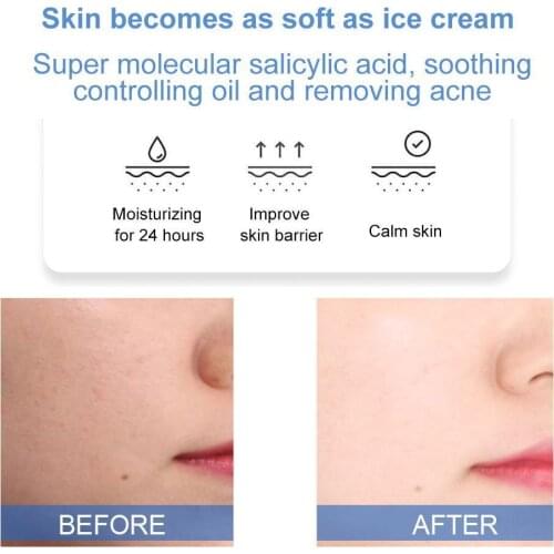 Salicylic Acid Ice Cream Mask Tube Set To Reduce Acne Marks Blackheads And Moisturizing D1Z6